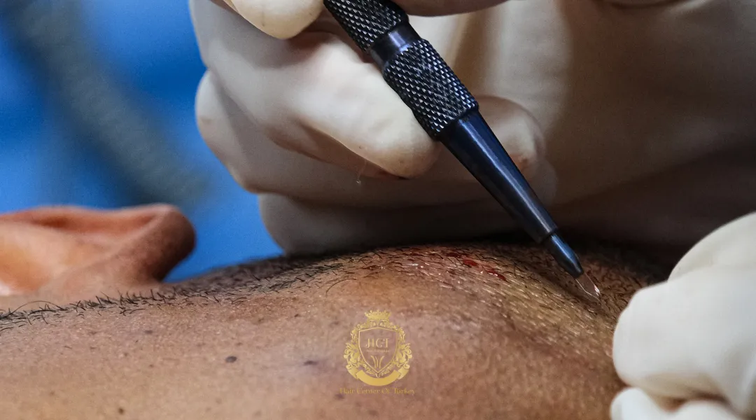 Percutaneous Hair Transplant Graft Survival Rate