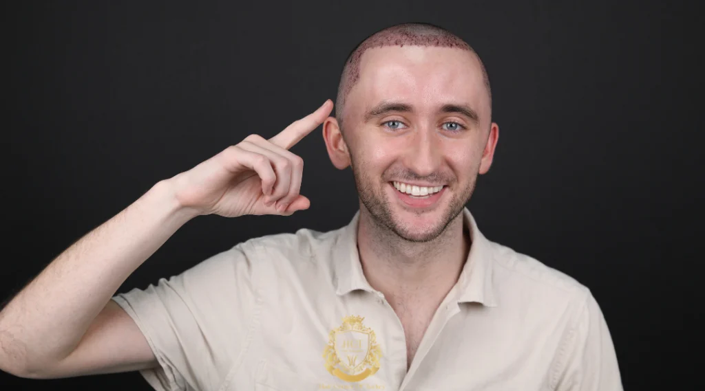 Traitement de greffe de cheveux à Edirne 3 Pour obtenir un résultat naturel, il faut commencer par définir la ligne frontale et bien gérer la zone donneuse