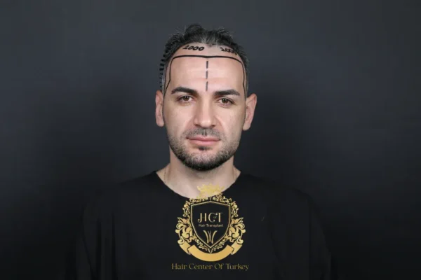 Saç Ekimi Sonrası Kabuklanma Olur Mu?