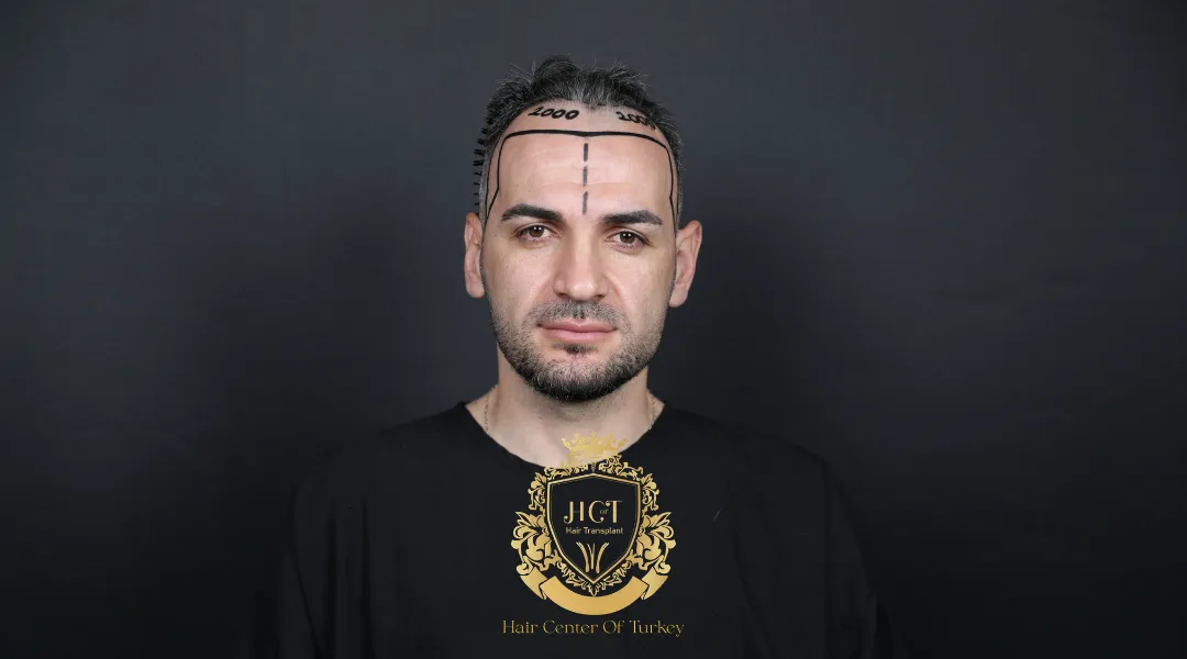 Scabbing After Hair Transplant: What's Normal?