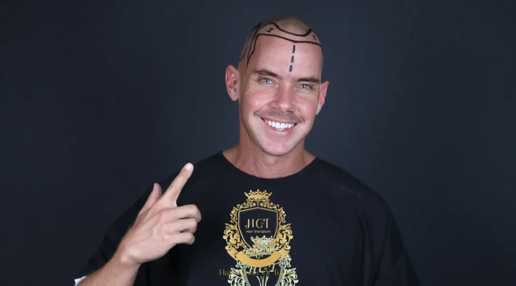 La greffe de cheveux provoque-t-elle le cancer ? La vraie réponse