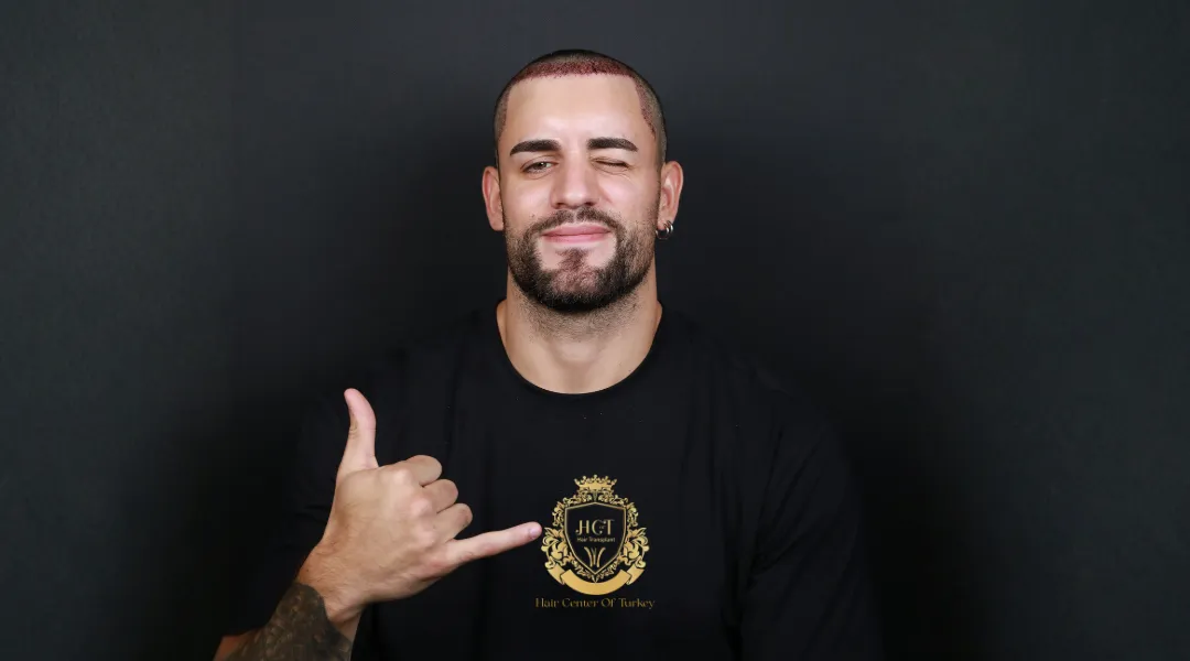 What Should We Keep in Mind After a Hair Transplant