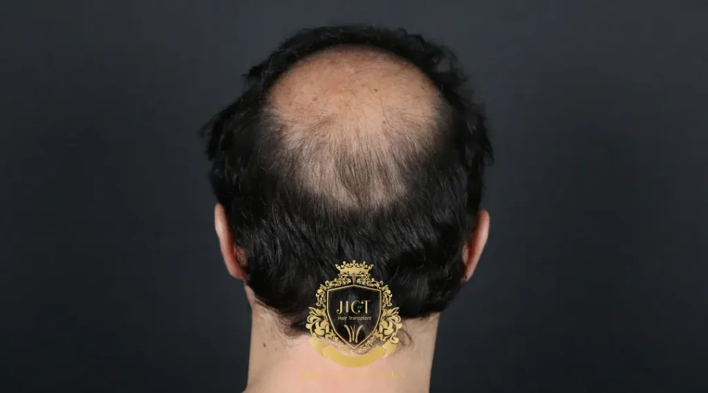 Does Hair Wax Cause Hair Loss? The Honest Take