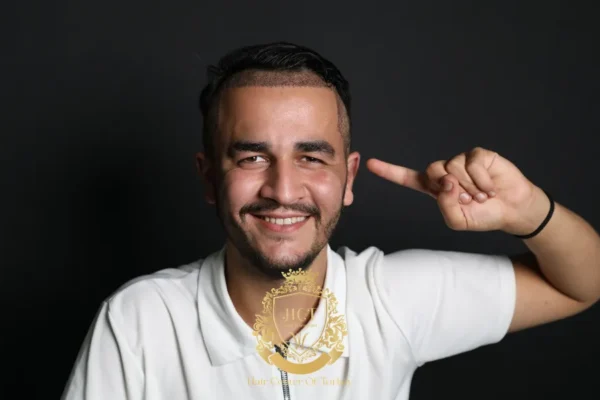 Quand une greffe de cheveux non rasés n’est pas la bonne solution