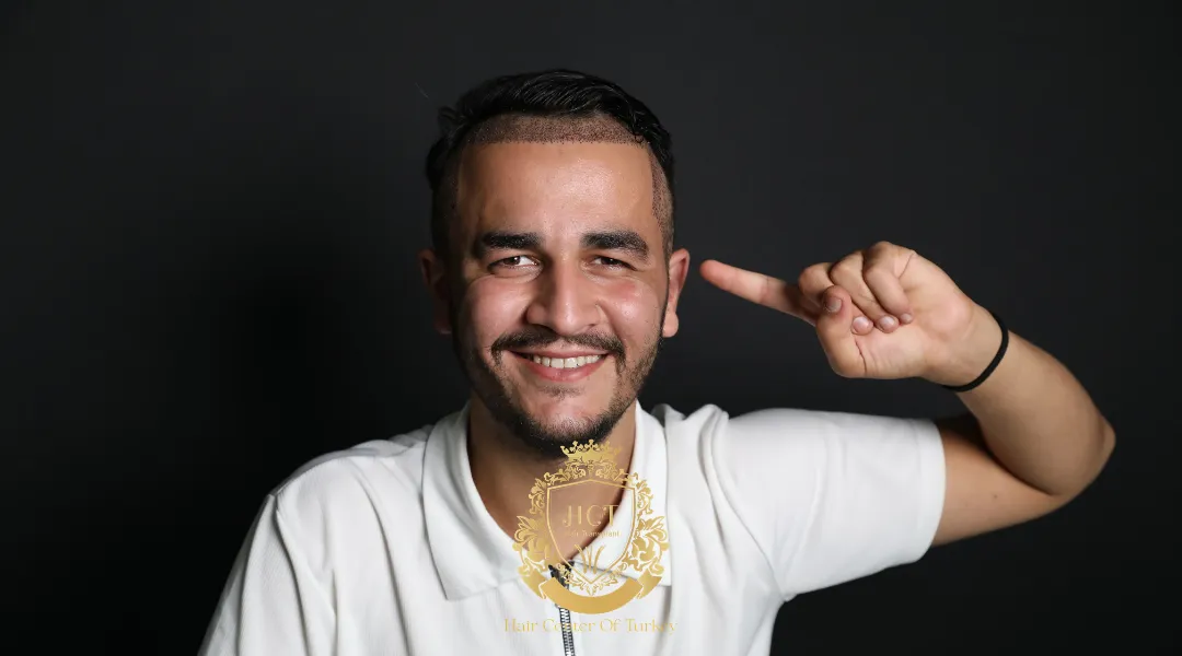 When an Unshaven Hair Transplant Isn't the Right Call