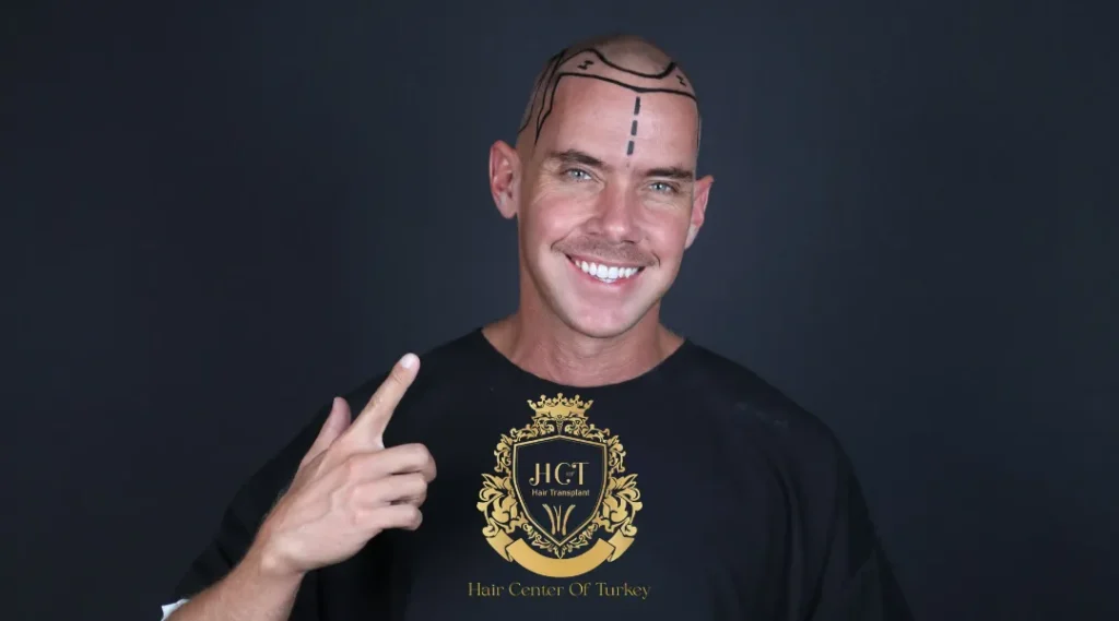 How to Prevent Hair Loss at a Young Age