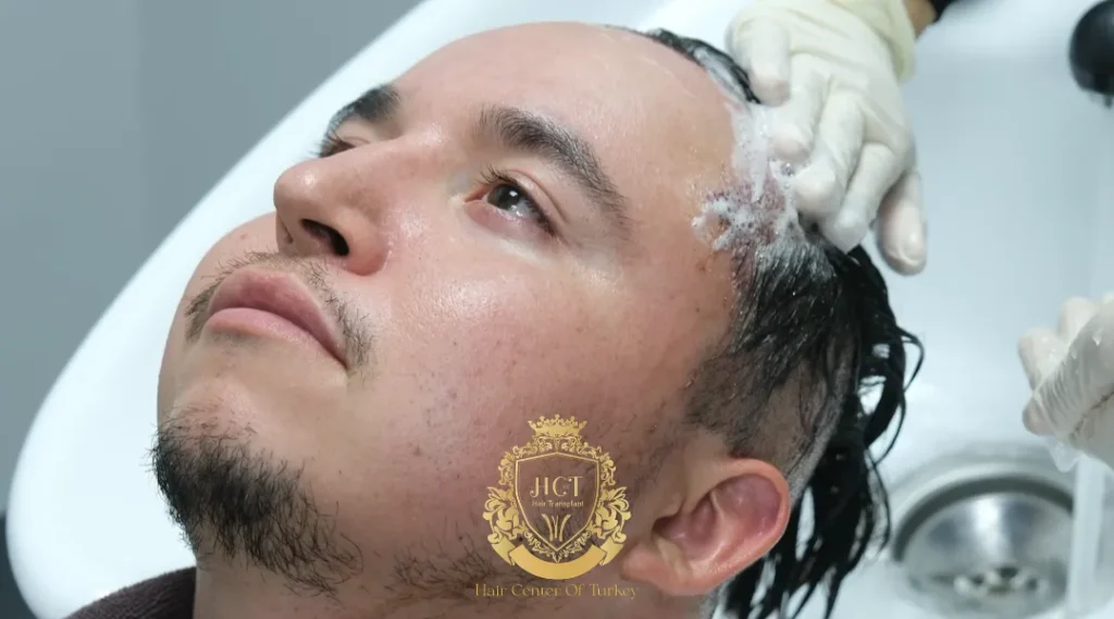 Hoe lang duurt jeuk na een haartransplantatie?