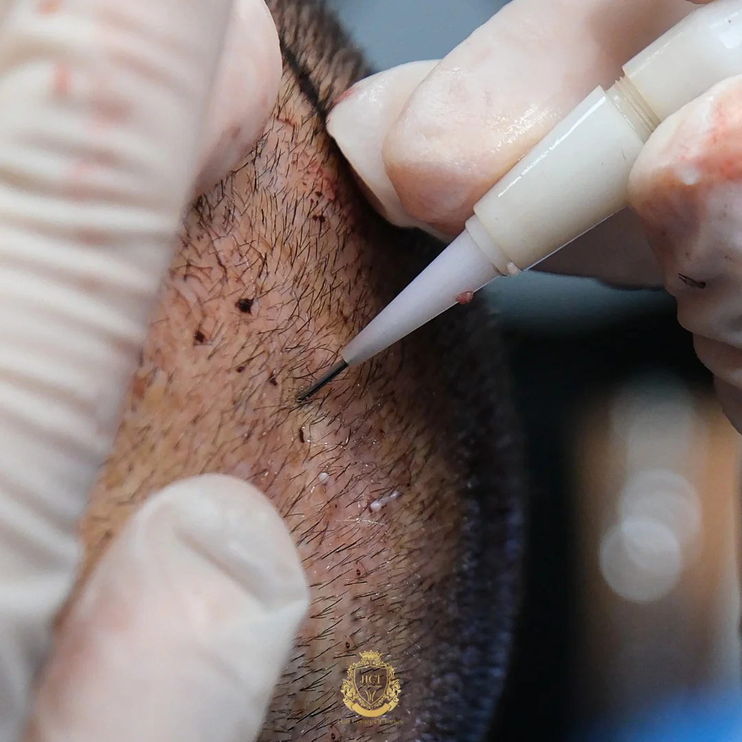 dhi-hair-transplant-in-turkey-ha