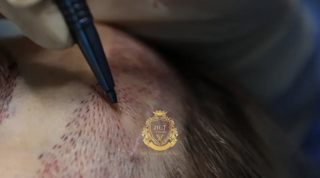 Sapphire FUE Hair Transplant in Istanbul