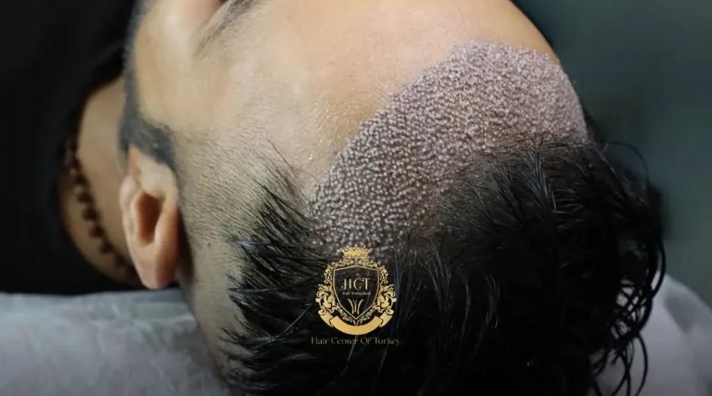 Hair Center Of Turkey Works With an Anesthesiologist