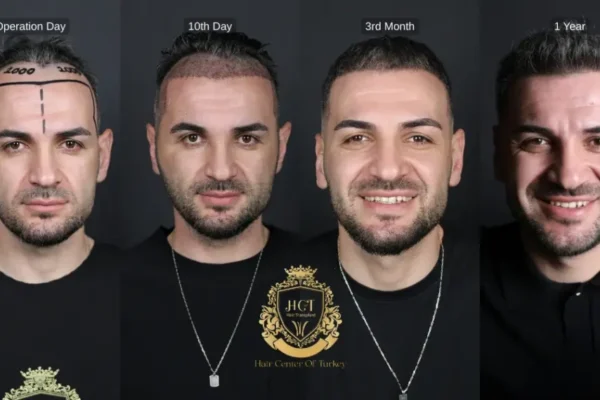 Hair Transplant Timeline
