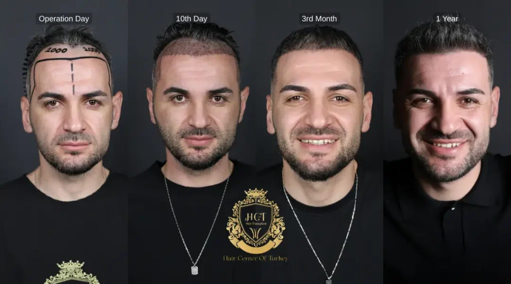 Hair Transplant Timeline