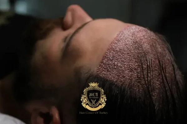 Is Hair Transplant Without Shaving Possible in Turkey?