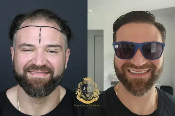 Places to Get a Hair Transplant in Istanbul