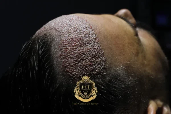 VIP Hair Transplant in Turkey With Hair Center Of Turkey