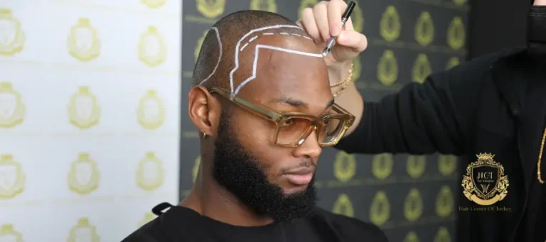 Why Is Hair Center Of Turkey a Pioneer in Afro Hair Transplantation?