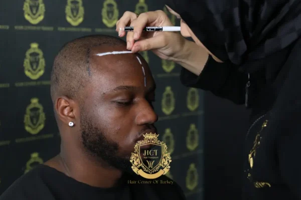 Why Should Hair Center Of Turkey Be Preferred for Hair Transplant Turkey?