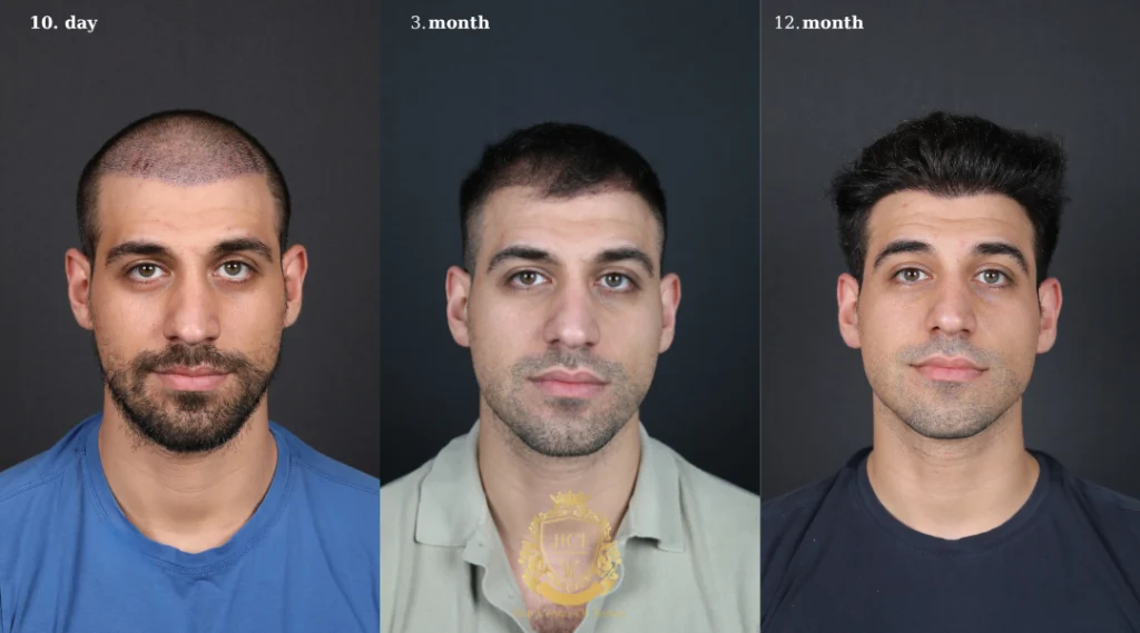 Will the Transplanted Hair Fall Out? A Detailed Guide 2 The Hair Growth Cycle After a Transplant