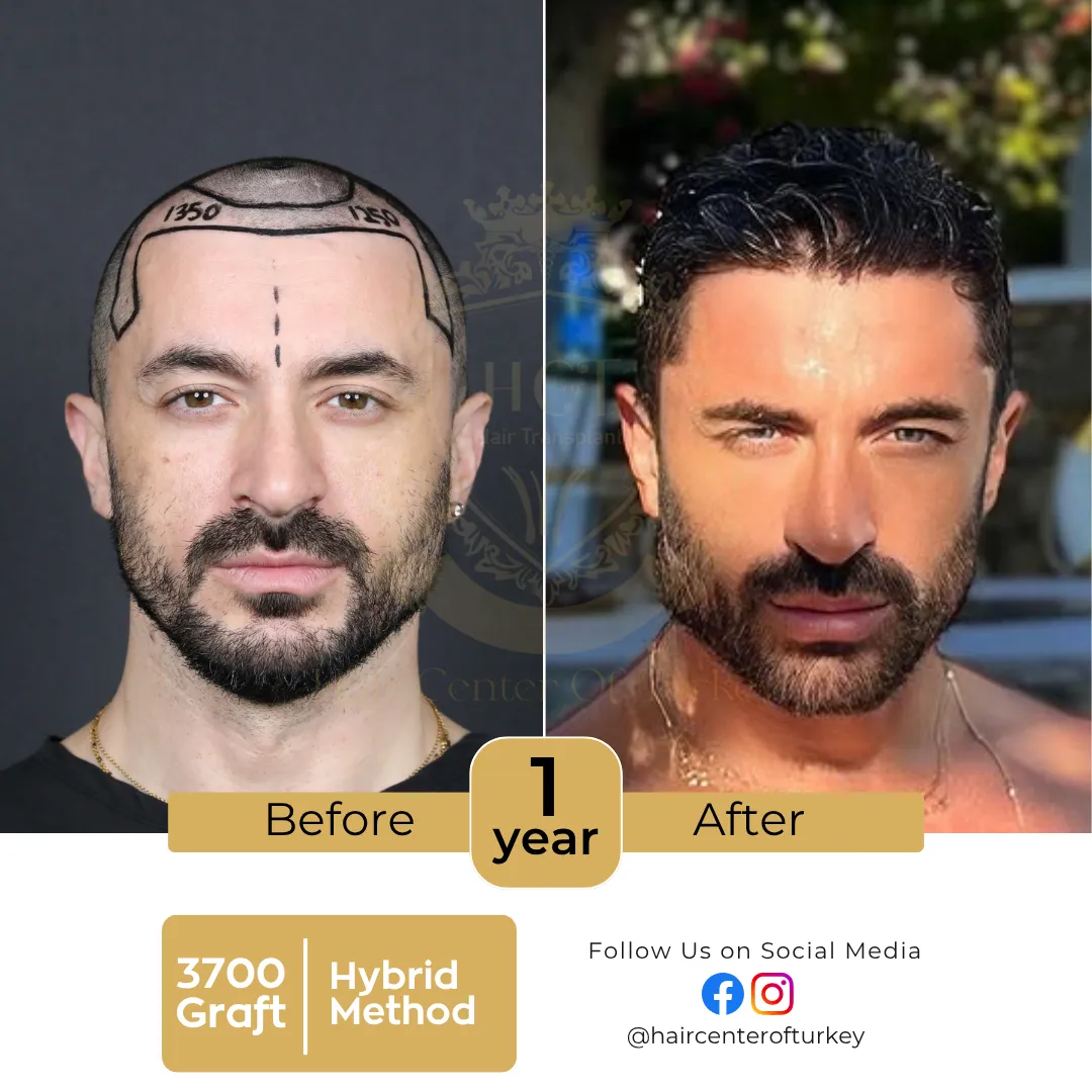 haircenterofturkey-hair-transplant-before-and-after-results-2026-1-6