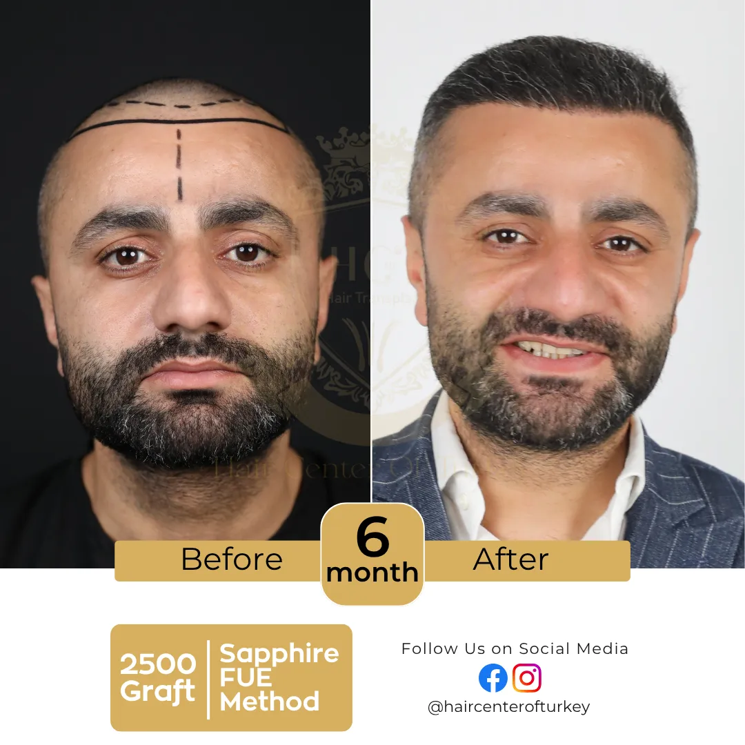 haircenterofturkey-hair-transplant-before-and-after-results-2026-10-6
