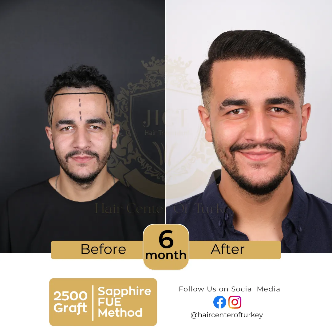 haircenterofturkey-hair-transplant-before-and-after-results-2026-11-6