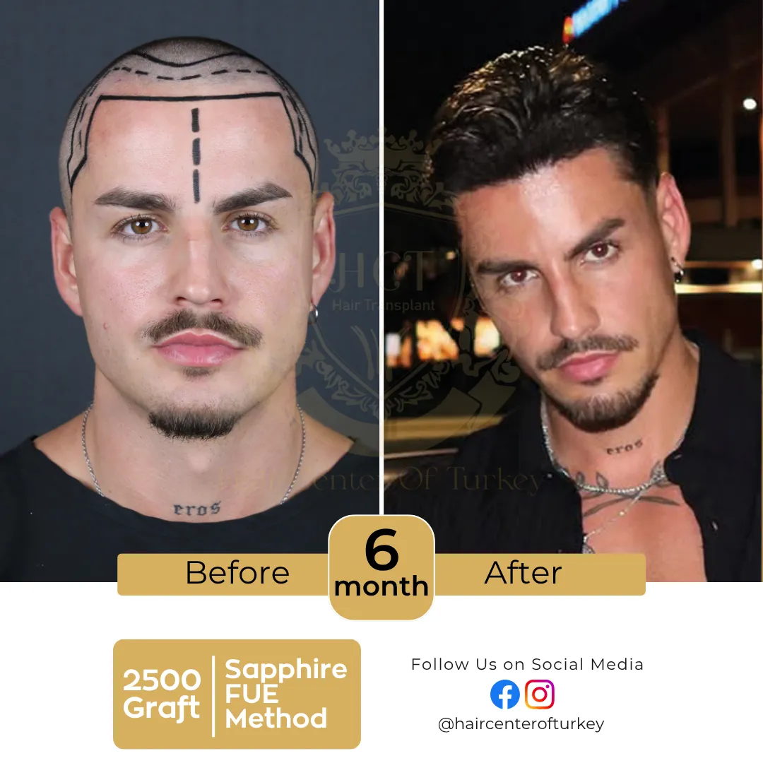haircenterofturkey-hair-transplant-before-and-after-results-2026-12-6
