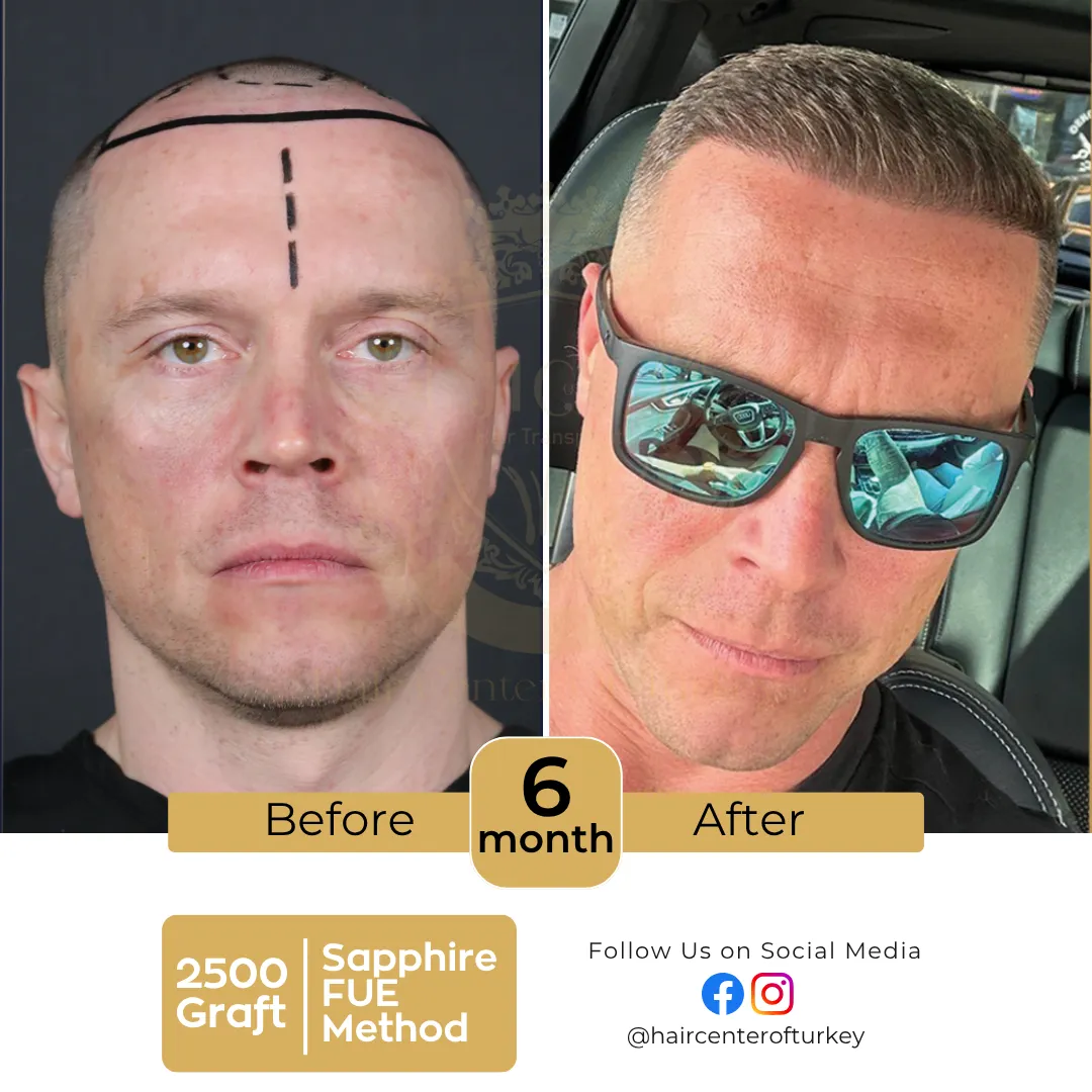 haircenterofturkey-hair-transplant-before-and-after-results-2026-13-6