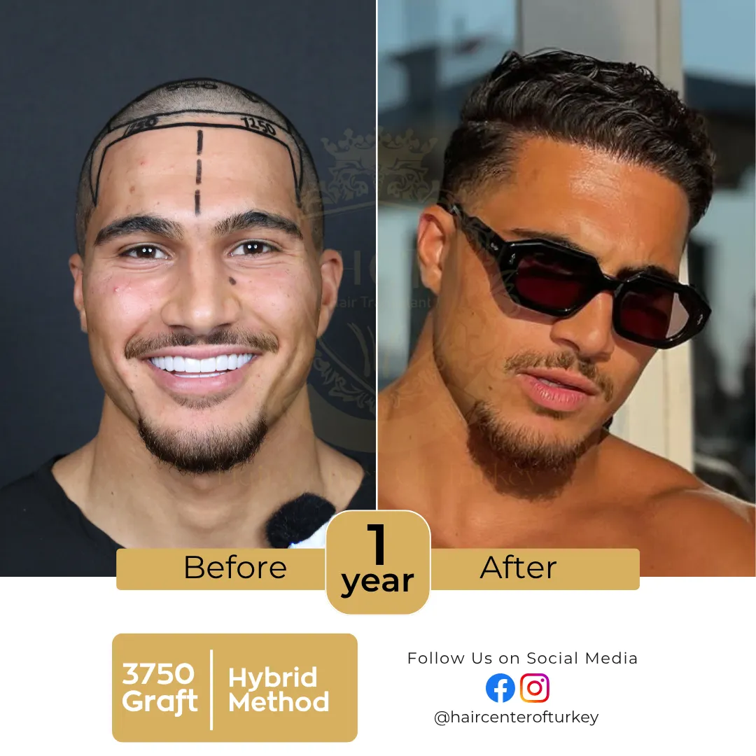 haircenterofturkey-hair-transplant-before-and-after-results-2026-2-6