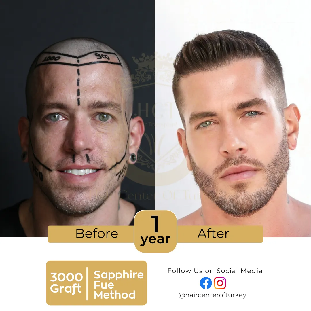 haircenterofturkey-hair-transplant-before-and-after-results-2026-4-6
