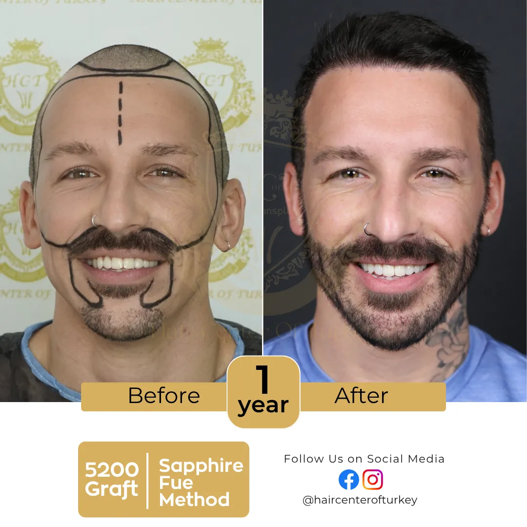 haircenterofturkey-hair-transplant-before-and-after-results-2026-5-6
