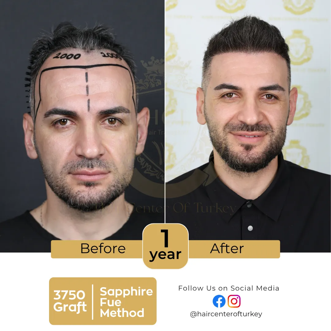 haircenterofturkey-hair-transplant-before-and-after-results-2026-6-6