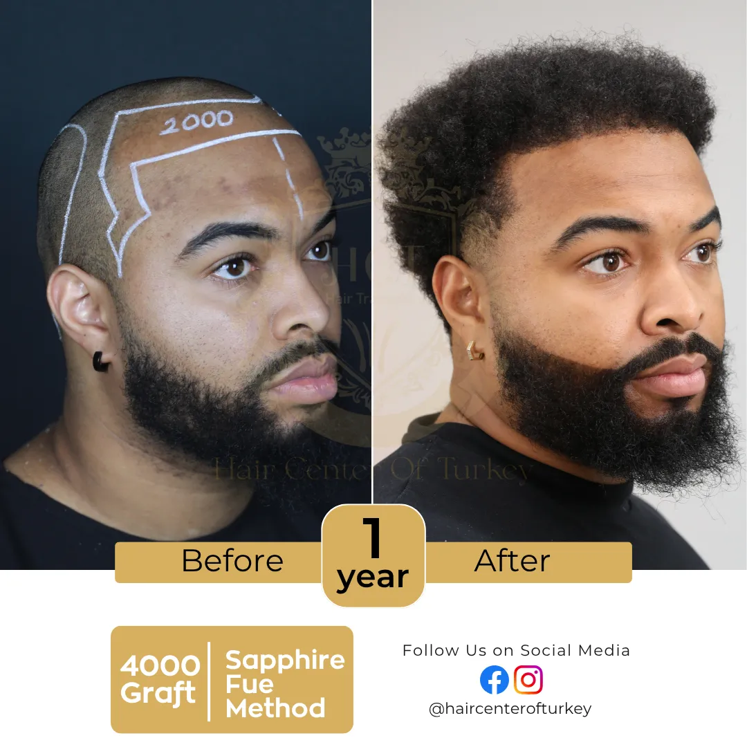 haircenterofturkey-hair-transplant-before-and-after-results-2026-7-6
