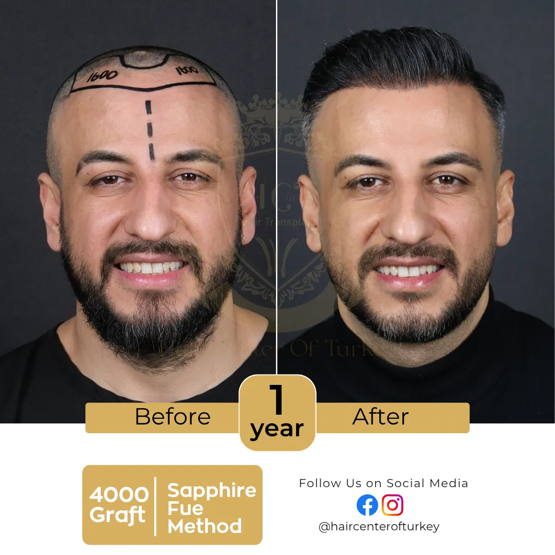 haircenterofturkey-hair-transplant-before-and-after-results-2026-8-6