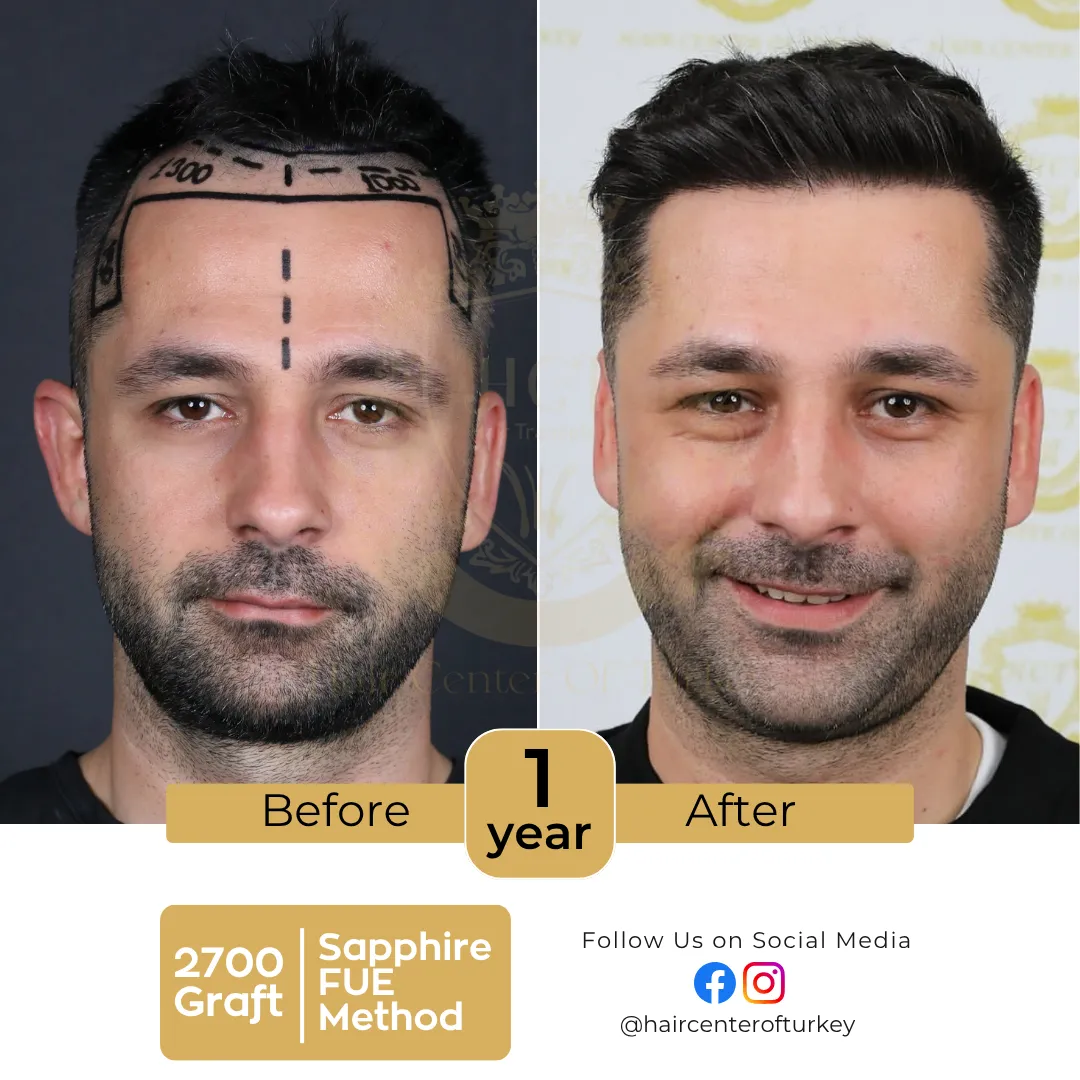 haircenterofturkey-hair-transplant-before-and-after-results-2026-9-6