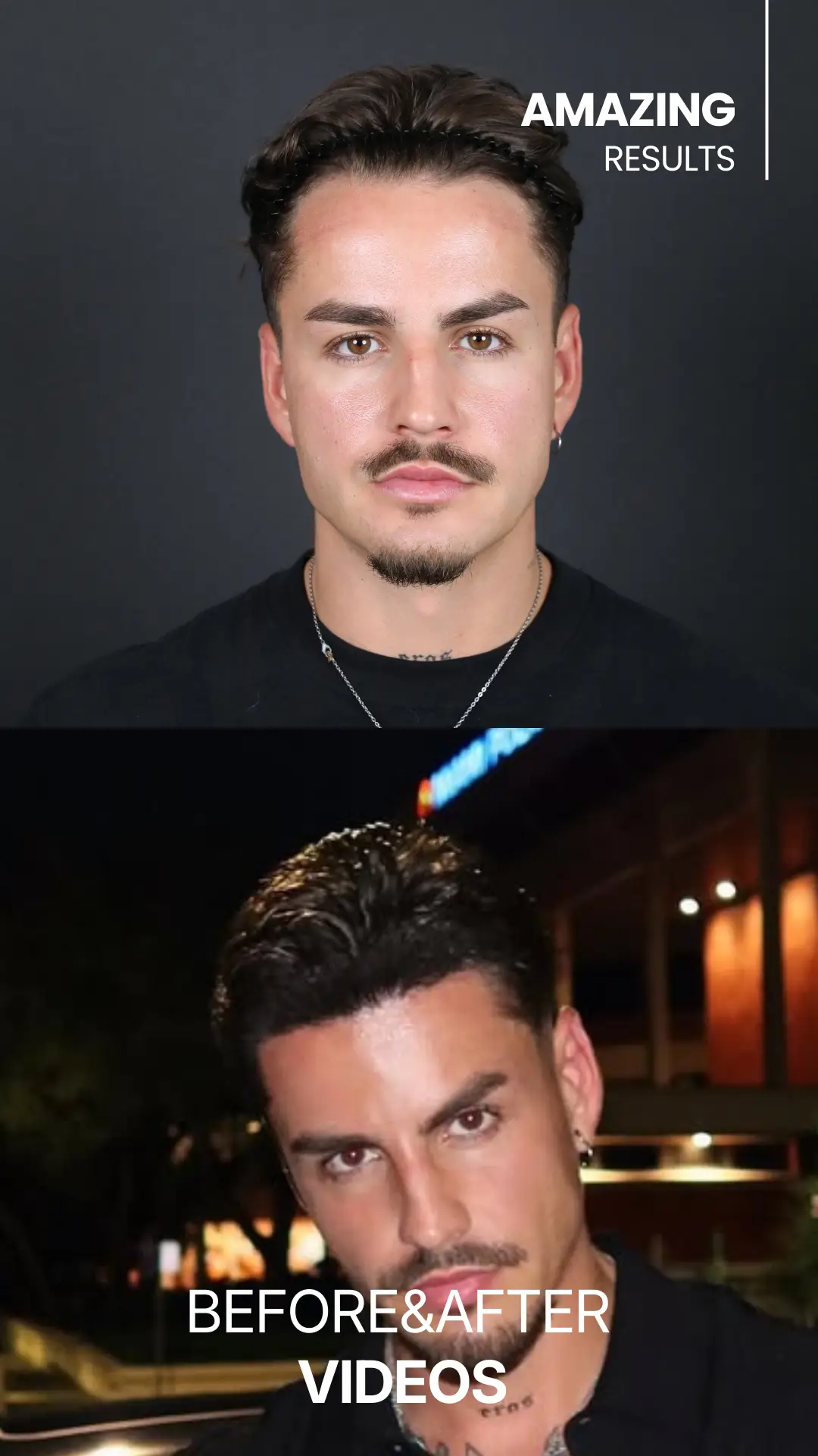 youtube-shorts-hair-transplant-before-and-after-hair-center-of-turkey-4