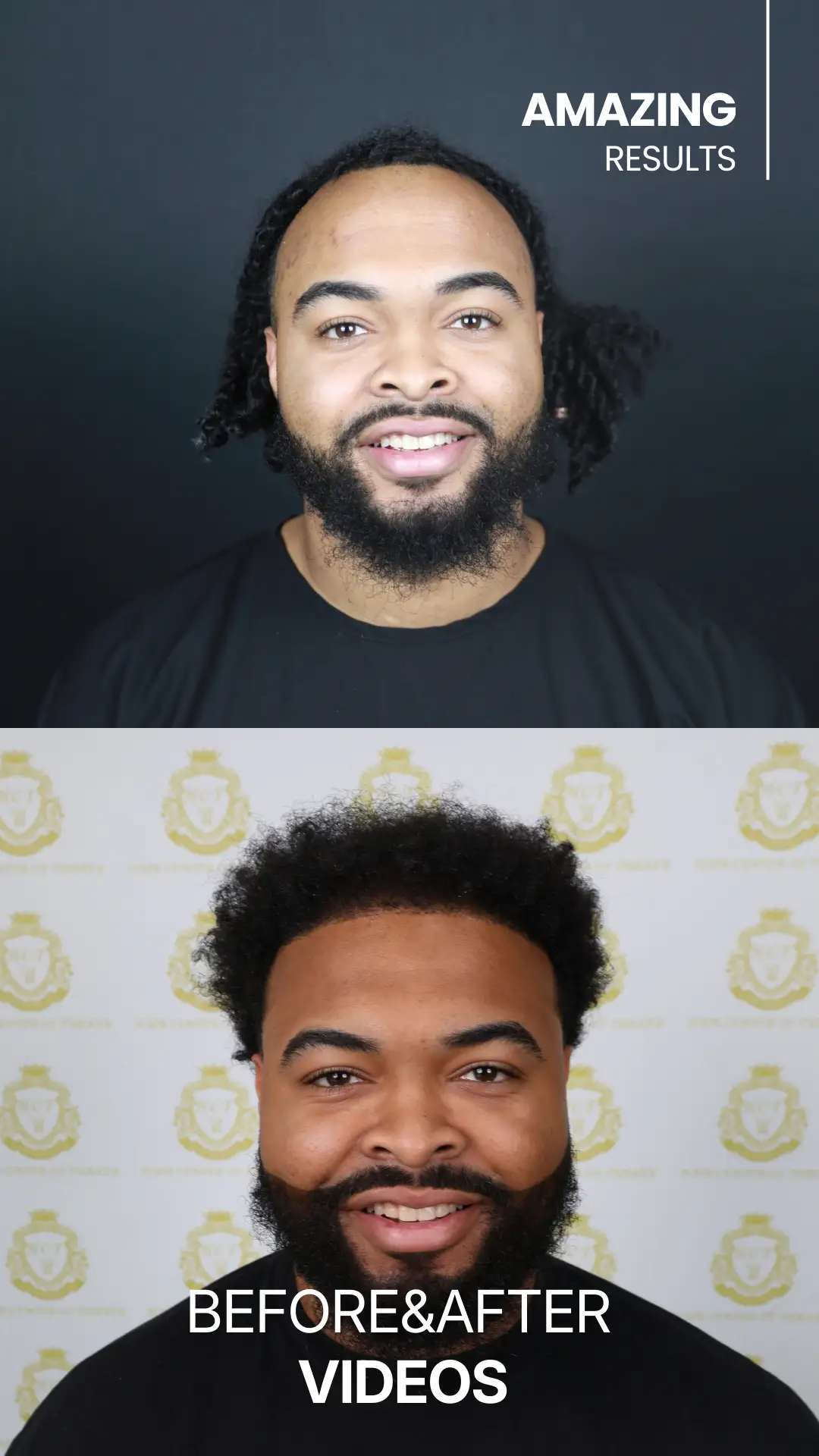 youtube-shorts-hair-transplant-before-and-after-hair-center-of-turkey-5