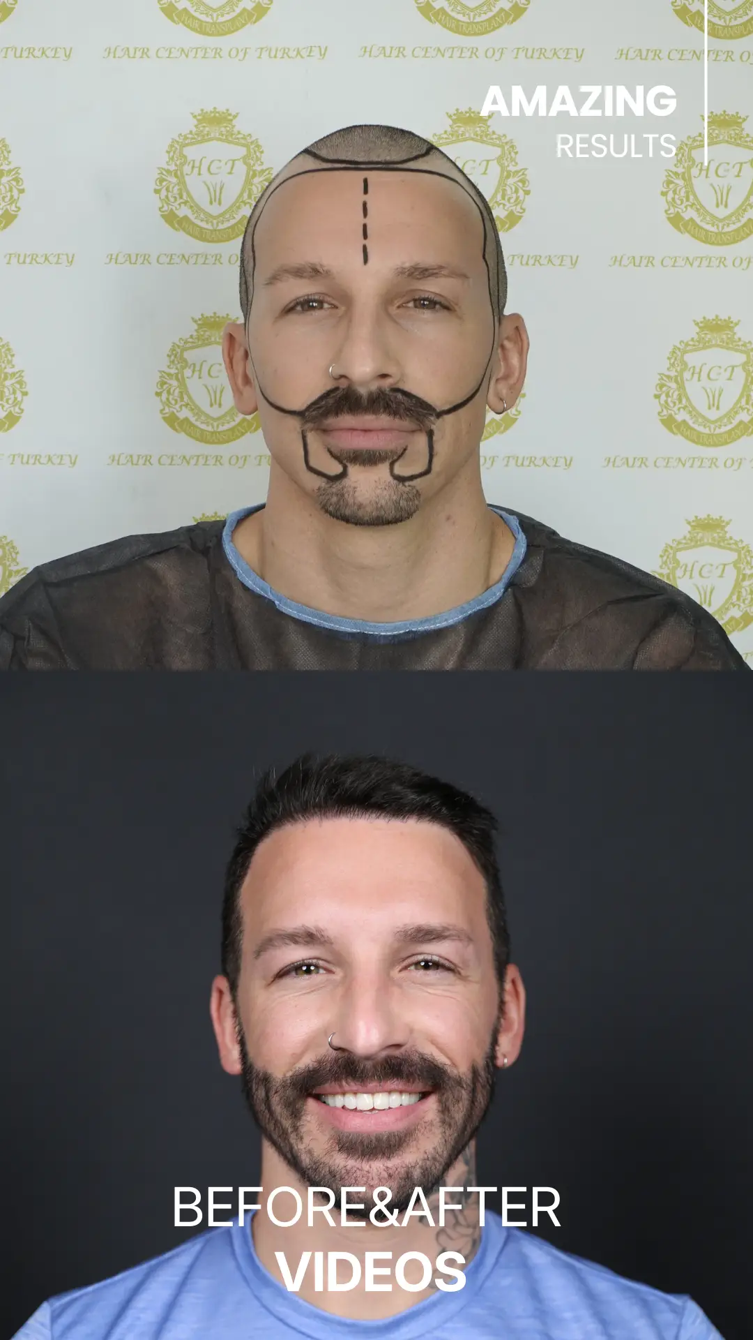 youtube-shorts-hair-transplant-before-and-after-hair-center-of-turkey-6
