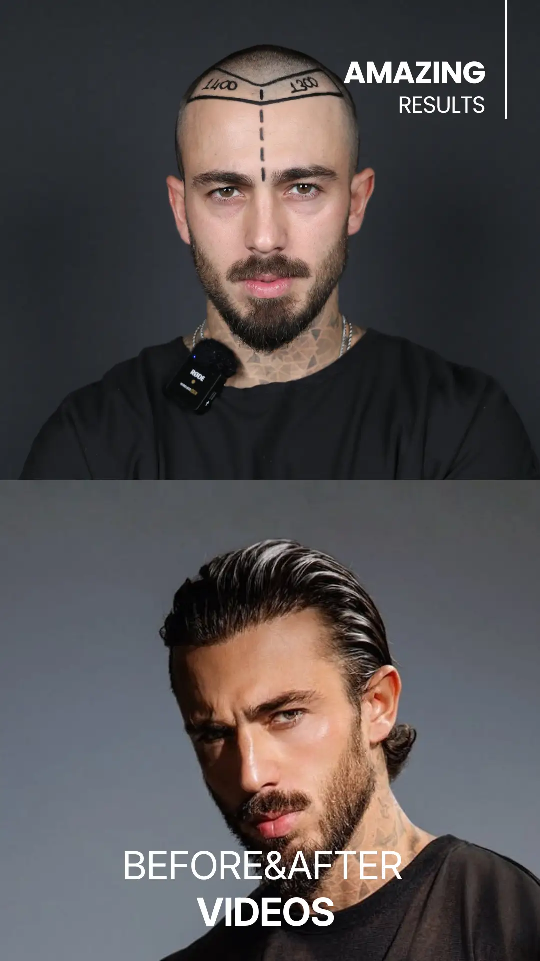 youtube-shorts-hair-transplant-before-and-after-hair-center-of-turkey