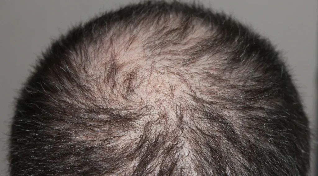 Saç Dökülmem Normal mi? 2 Common Causes of Hair Loss