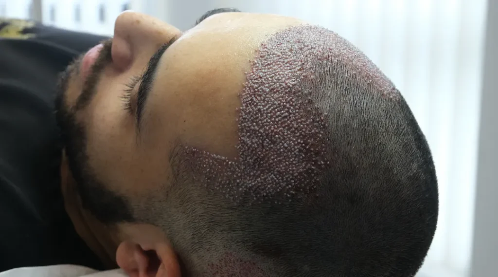 Saç Dökülmem Normal mi? 4 Hair Center of Turkey Services