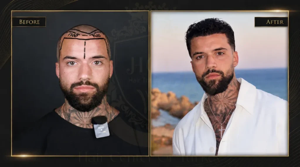 Hair Transplant Istanbul vs. Other Turkish Cities: Cost Comparison