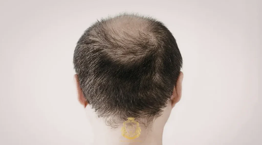 Common Causes of Hair Loss in Men and Women