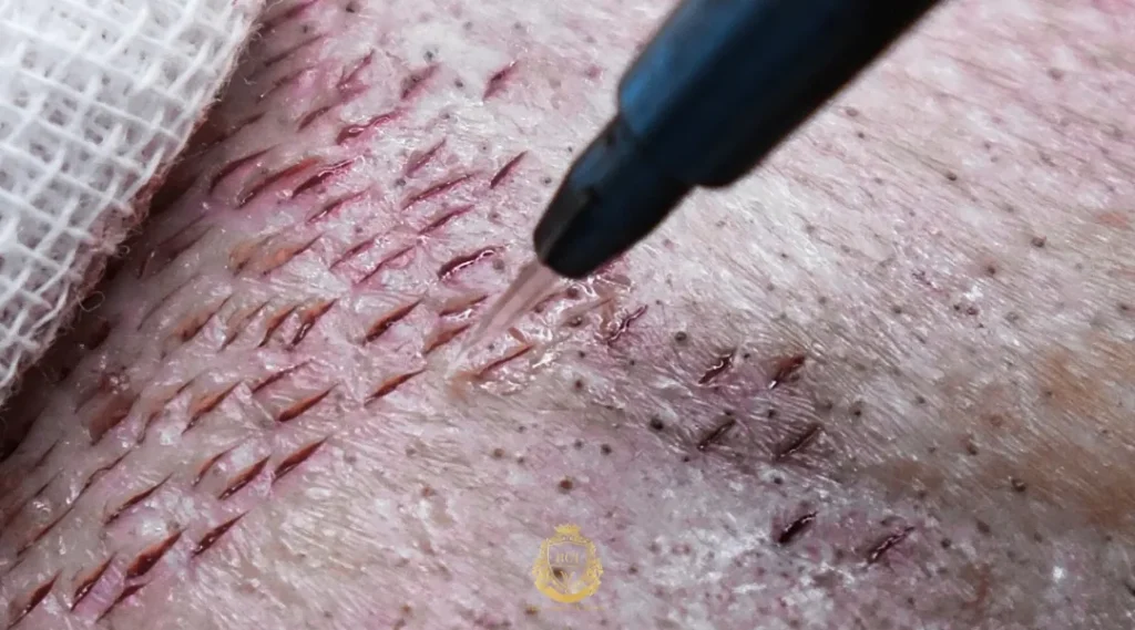 Are Promises Of Very High Graft Counts In Turkey Realistic? 3 How Reputable Turkish Clinics Approach A High Graft Hair Transplant Safely
