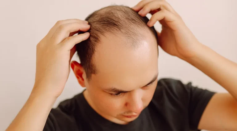Is My Hair Loss Normal