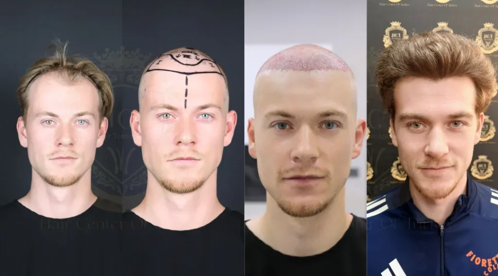 Recovery and the Flight-Home Timeline at Hair Center of Turkey