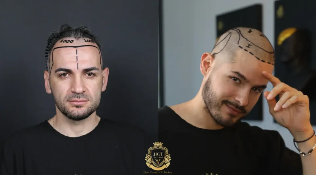 Is a Partially Shaven Hair Transplant Right for You? 3 Is a Partially Shaven Hair Transplant Right for You?