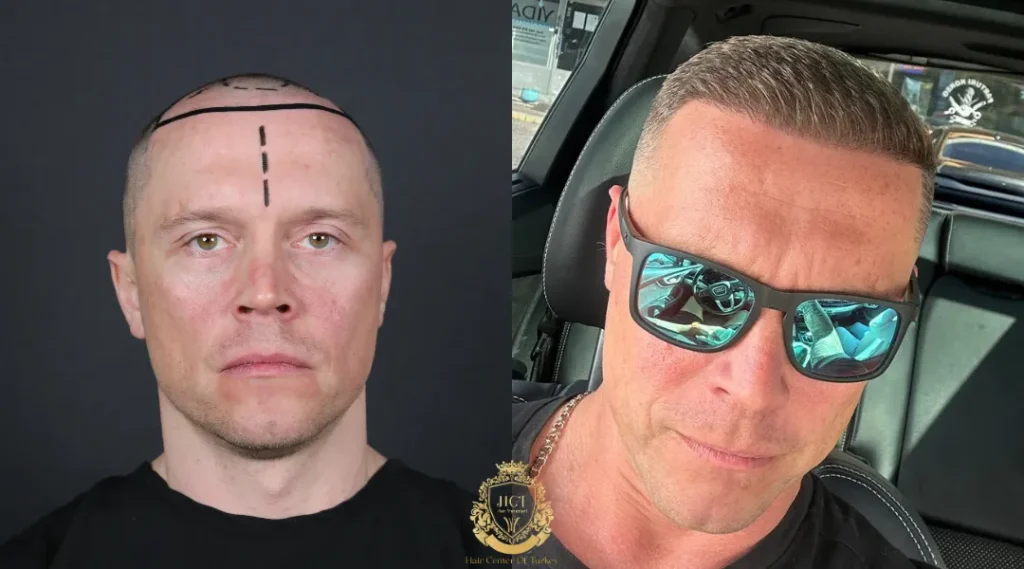 Is a Partially Shaven Hair Transplant Right for You? 5 Is a Partially Shaven Hair Transplant Right for You?