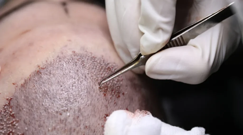 Why Do Americans Go to Turkey Hair Transplant?