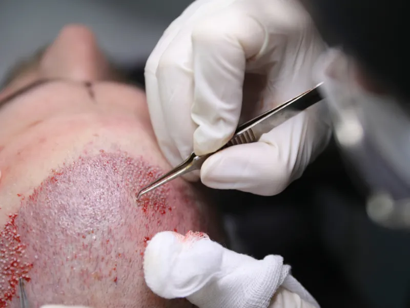 Restaurarea părului la standarde internaționale