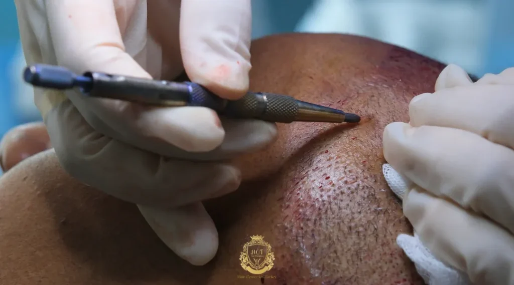 Is It Safe to Get a Hair Transplant in Turkey for Afro Hair? 4 afro hair transplant
